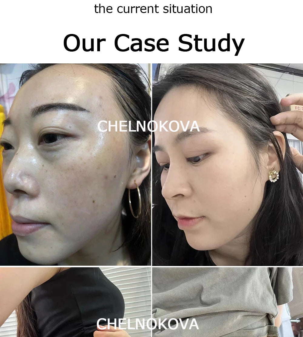 citric acid 40% for peeling facial face skin 5ml 10ml powder cleaning for you blackhead aha Brightening Man Makeup